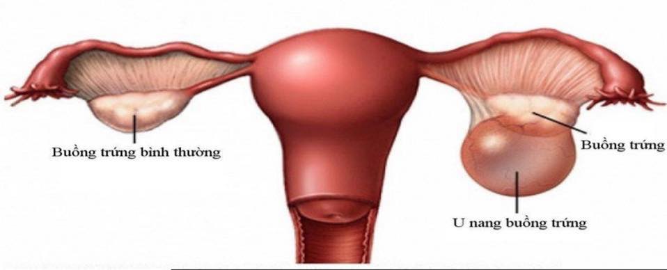 NHỮNG ĐIỀU CẦN BIẾT VỀ U NANG BUỒNG TRỨNG